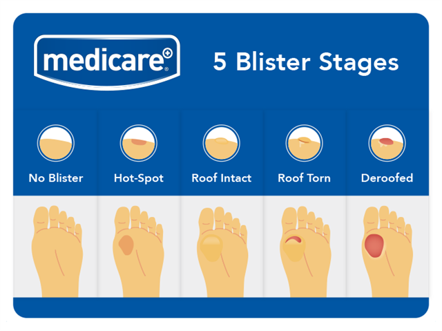 What is a blister deals